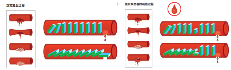 突破血友病治疗困局，国产重组人凝血因子Ⅶa带来止血新革命