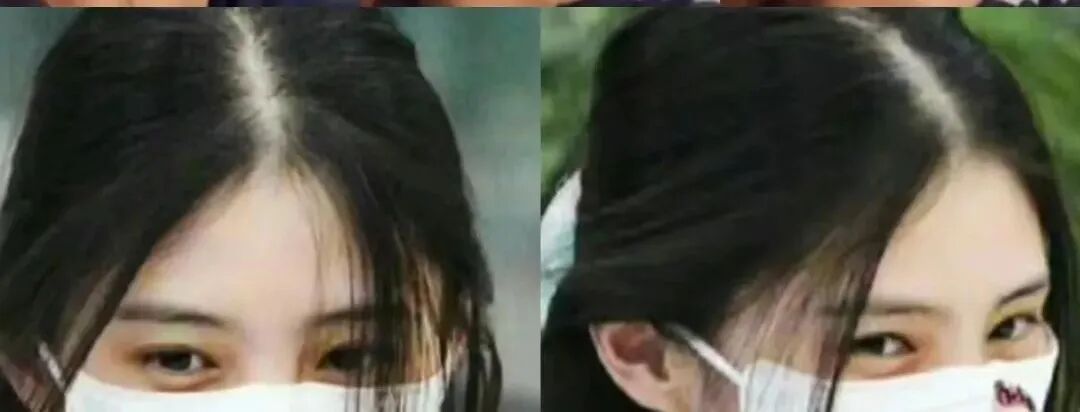 不想输在“发际线”!选对方法也能get高颅顶!杏林植发 不想输在“发际线”!选对方法也能get高颅顶!杏林植发