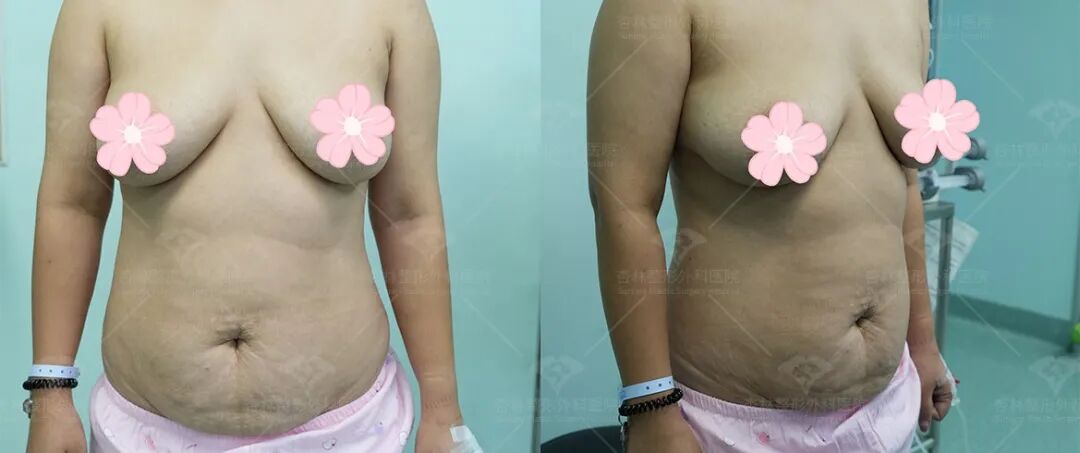 产后难收“游泳圈”？做好这件事，腰腹紧致！杏林吸脂