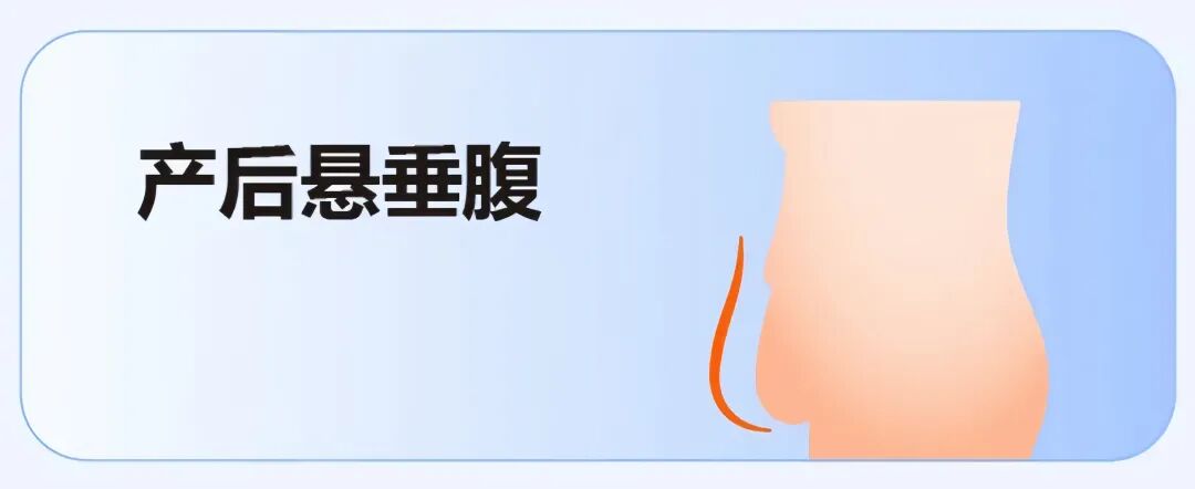 产后肚子大有3种类型?杏林腹壁整形术