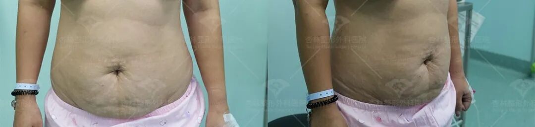 产后肚子大有3种类型?杏林腹壁整形术 产后肚子大有3种类型?杏林腹壁整形术