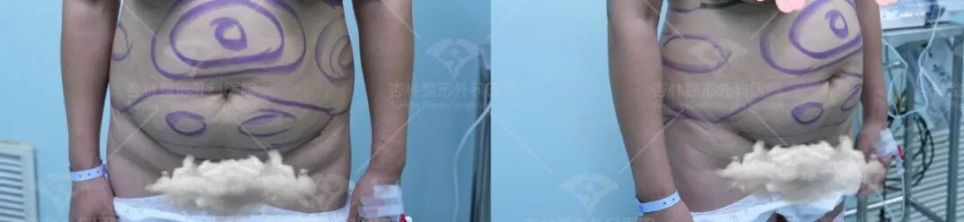 产后肚子大有3种类型?杏林腹壁整形术 产后肚子大有3种类型?杏林腹壁整形术