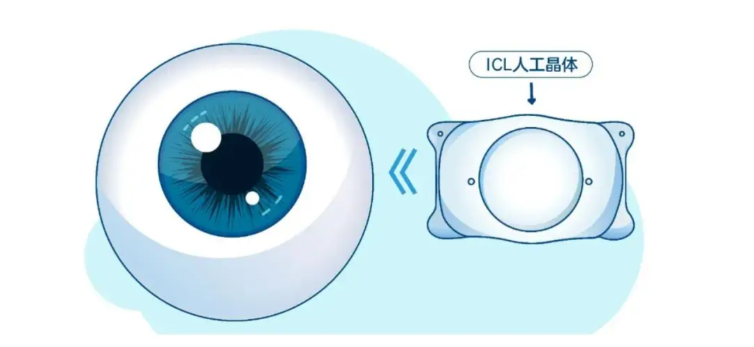 郑州EVO+ ICL(V5)和ICL（V4C）哪种好 尖峰眼科如何