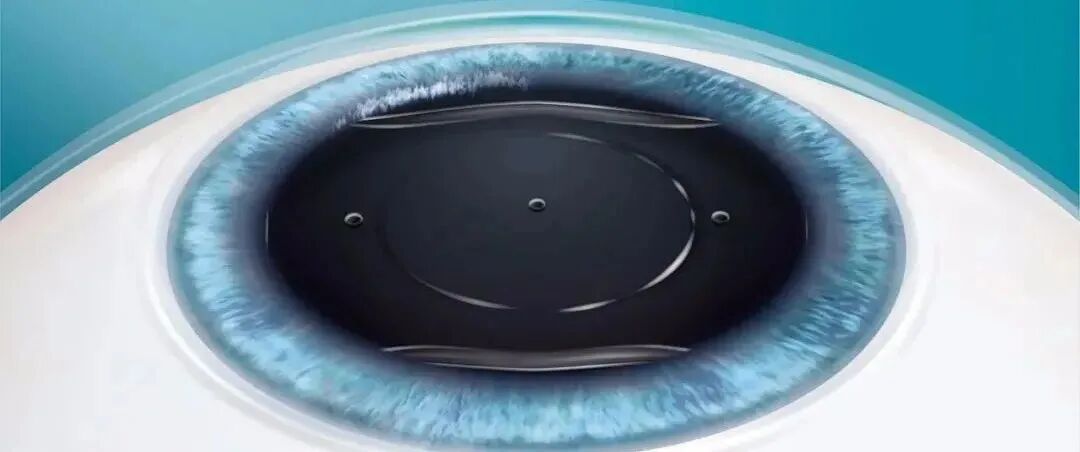 刘保松博士谈ICL晶体植入问题——尖峰眼科 刘保松博士谈ICL晶体植入问题——尖峰眼科