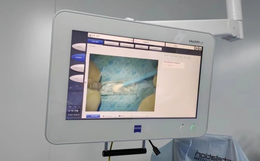 刘保松博士谈ICL晶体植入问题——尖峰眼科 刘保松博士谈ICL晶体植入问题——尖峰眼科