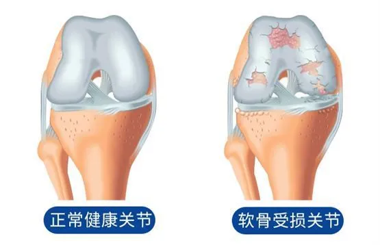 硫酸氨糖与盐酸氨糖，科学对比与理性选择指南
