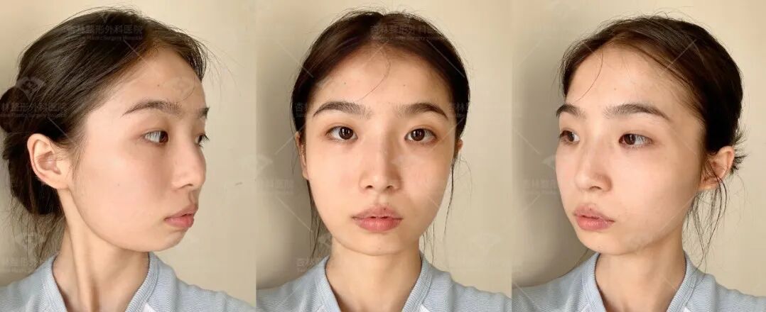 6种嘴凸表现，你是哪一种？杏林改脸型